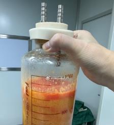 永州水动力吸脂手术要做多久？